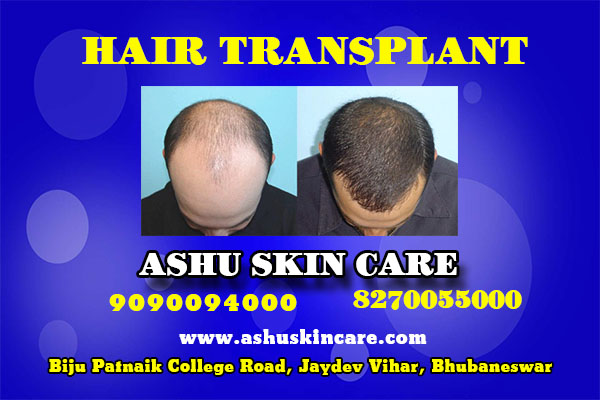best hair transplant clinic in bhubaneswar, odisha